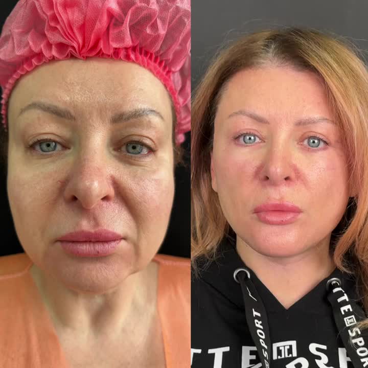 медицинское фото результата хирургической подтяжки лица